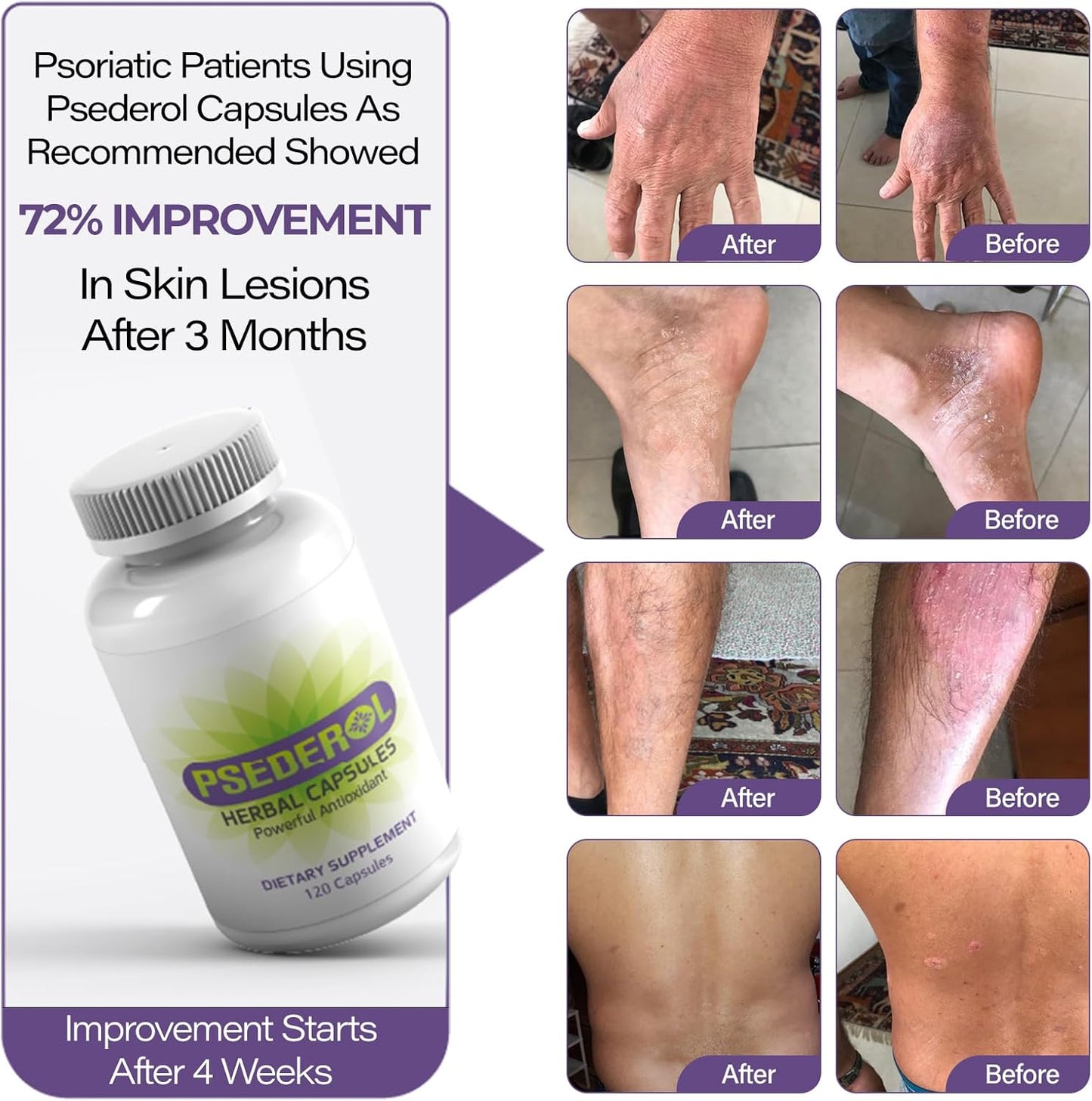 120 Herbal Capsules for Psoriasis Support, Natural Ayurvedic Supplement with 6 Antioxidant Herbs for Dry and Itchy Skin