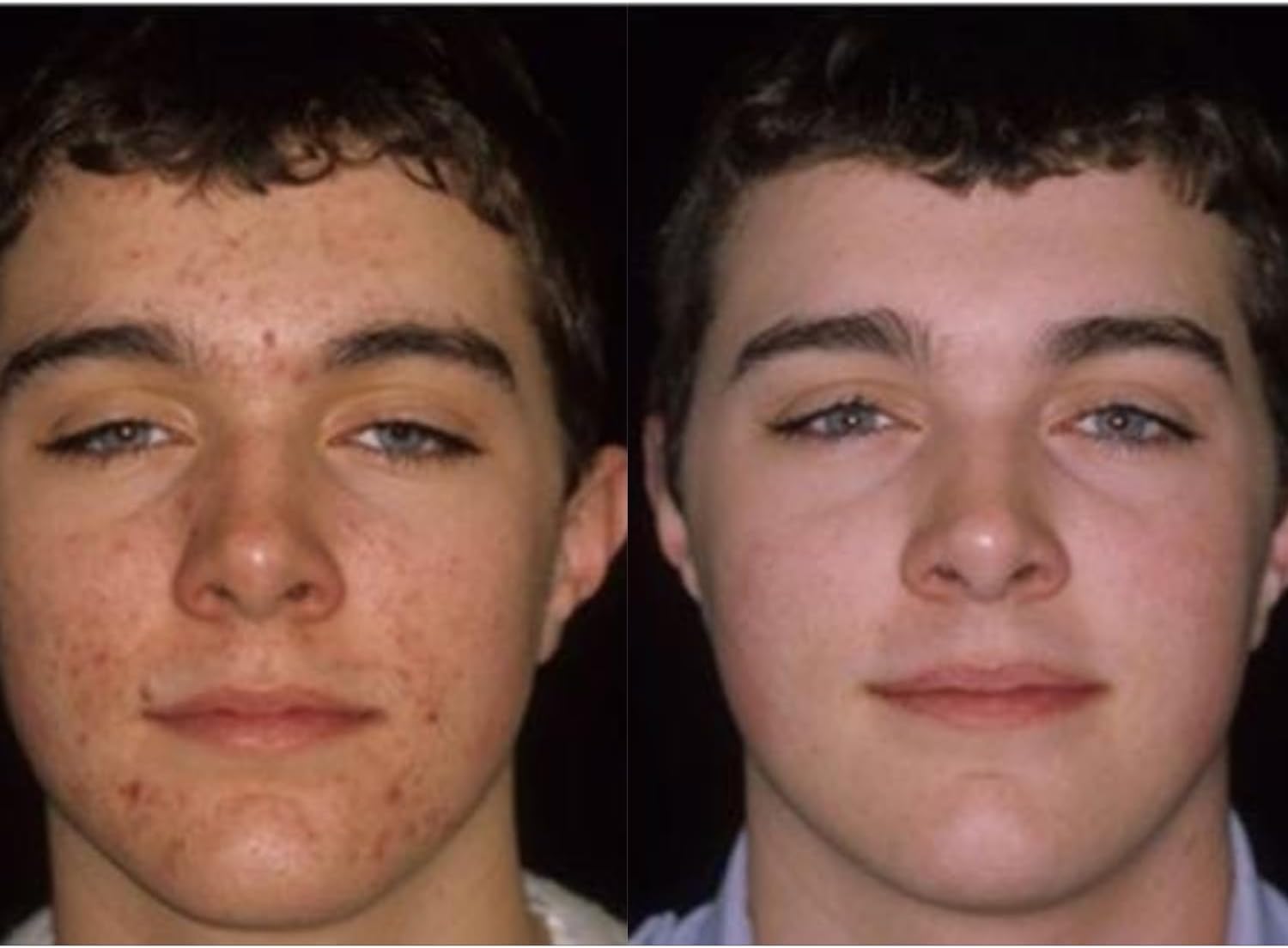 Acnetame 3 Pack: Hormonal Pimple Tablets for Acne Treatment - Vitamin Supplements to Clear Oily Skin for Women, Men, Teens, and Adults