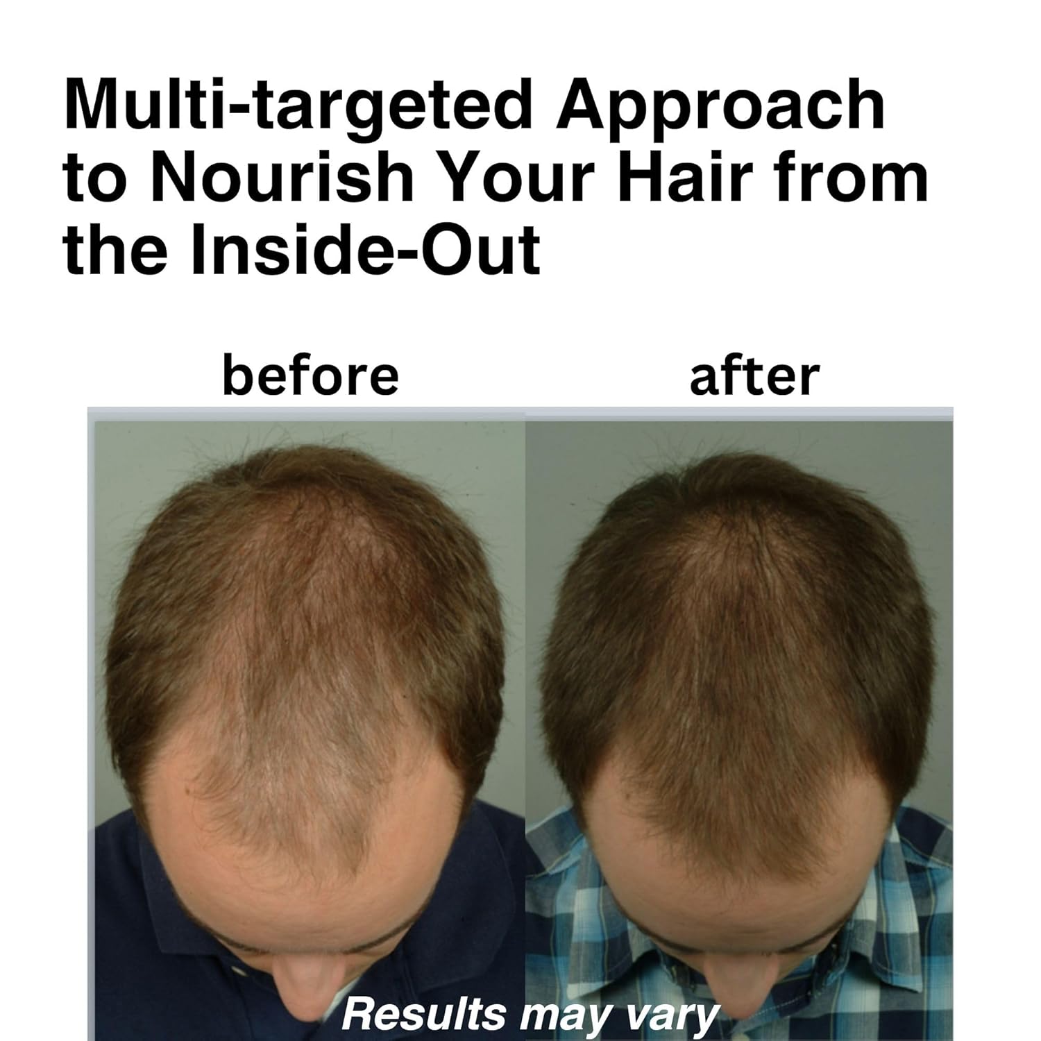 DrSG DHT Blocker Supplement for Hair Growth - Saw Palmetto, Pumpkin Seed, Stinging Nettle - 60 Capsules for Men and Women