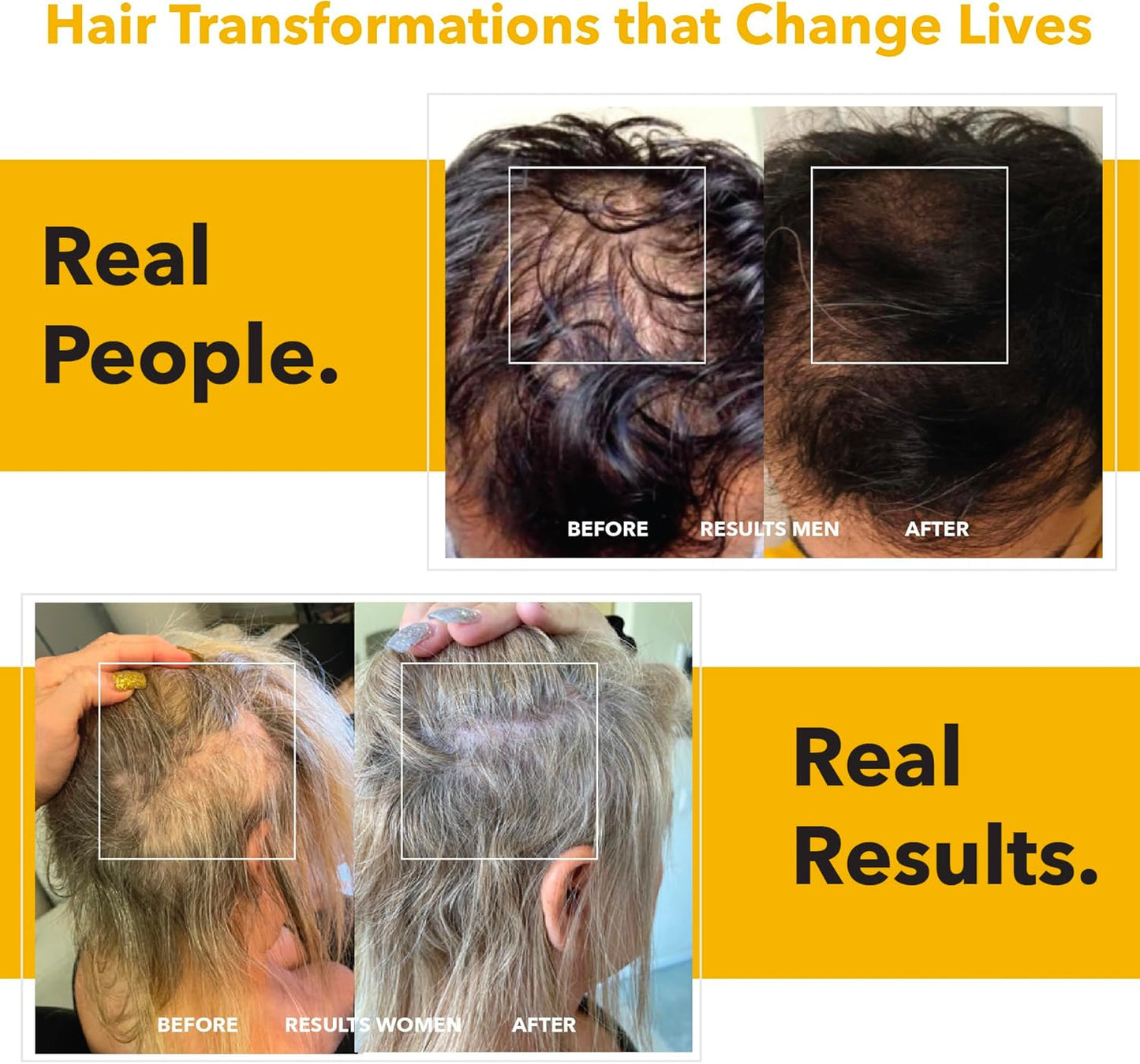 HairSmart DHT Blocker Supplement for Men - Hair Regrowth Vitamins with Saw Palmetto, Stinging Nettle, Green Tea, Pygeum Bark & Pumpkin Seed - Gluten-Free Formula (180 Count)