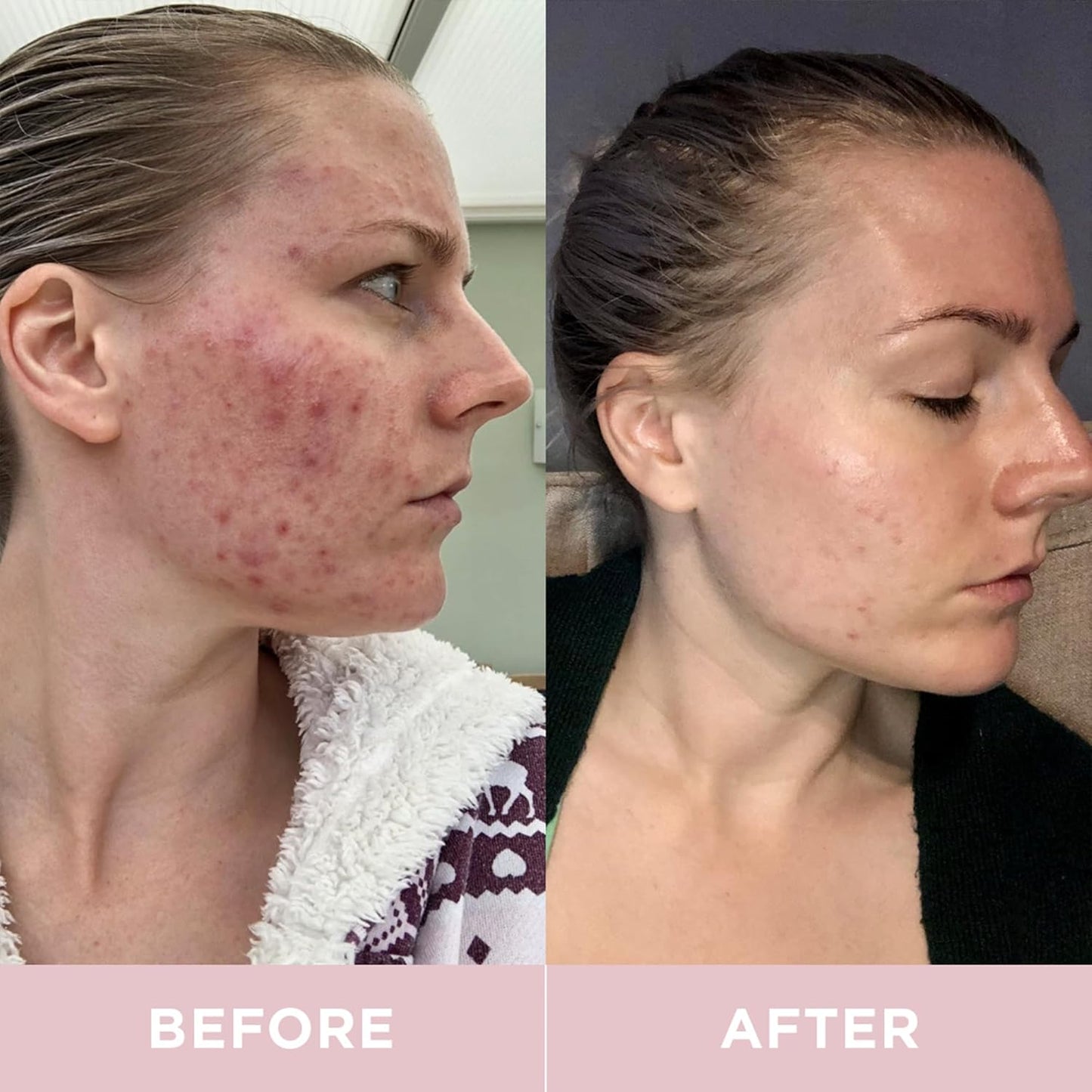Hydrolyzed Marine Collagen Drink with Hyaluronic Acid & Aloe Vera for Skin, Hair, Nails, & Joints - Lemon & Lime (14 Days)