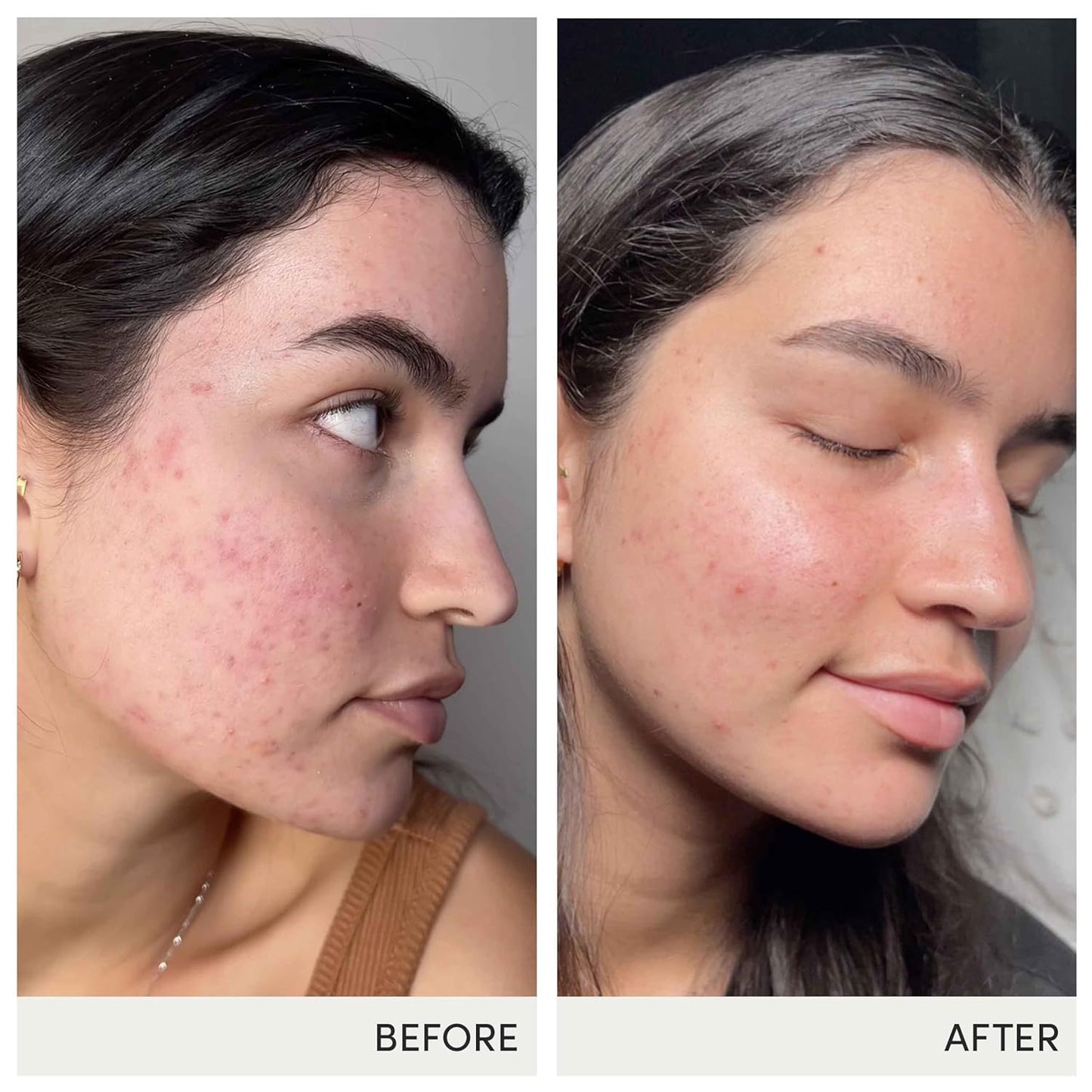 jane iredale Skin Accumax Capsules: Acne-Fighting Supplement with Vitamin A, C, and E - Vegan & Gluten-Free