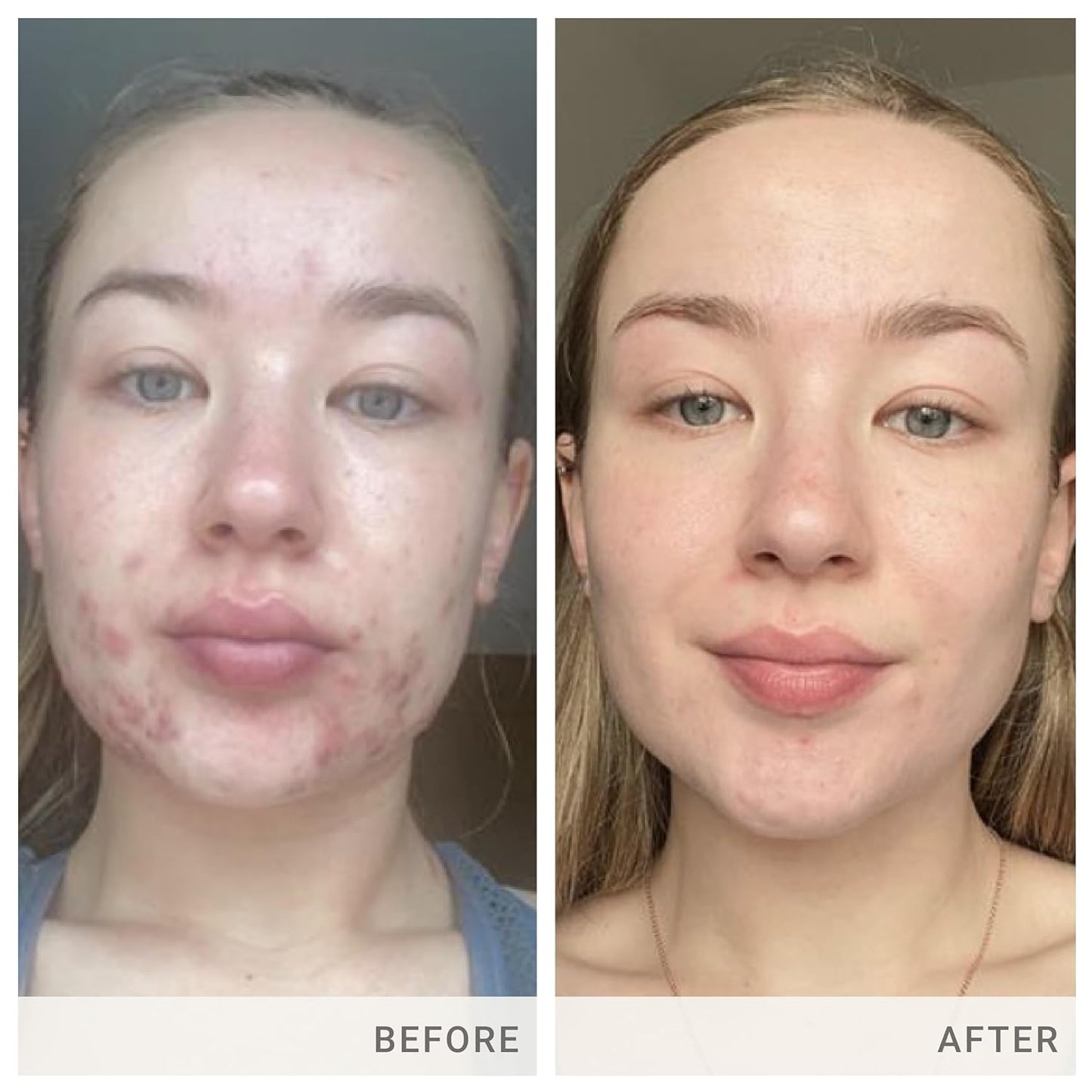 jane iredale Skin Accumax Capsules: Acne Treatment with Vitamin A, C, & E - Vegan & Gluten-Free