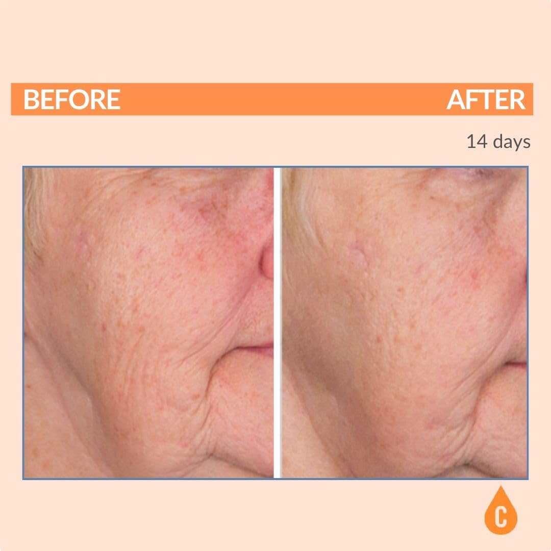 Vitamin C Ester Pads with Hyaluronic Acid for Anti-Aging Facial Treatment - Fruit Extracts - Pre-Soaked Facial Disc - 60 Count