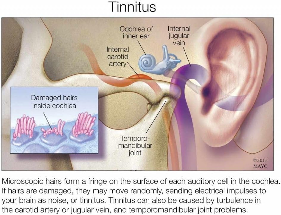 X-Tinnitus: Natural Remedy for Tinnitus - 120 Capsules - Made in USA