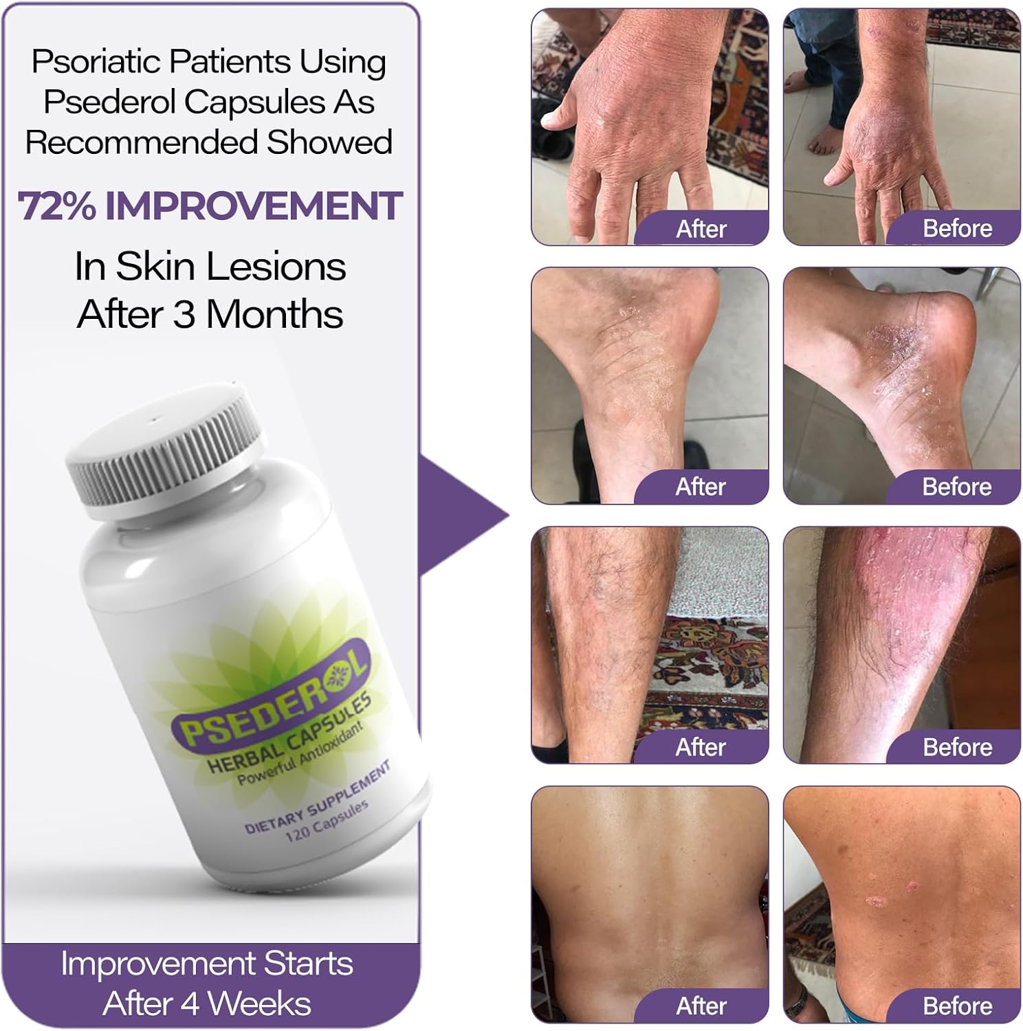 120 Herbal Capsules for Psoriasis Support, Natural Ayurvedic Supplement with 6 Antioxidant Herbs for Dry and Itchy Skin
