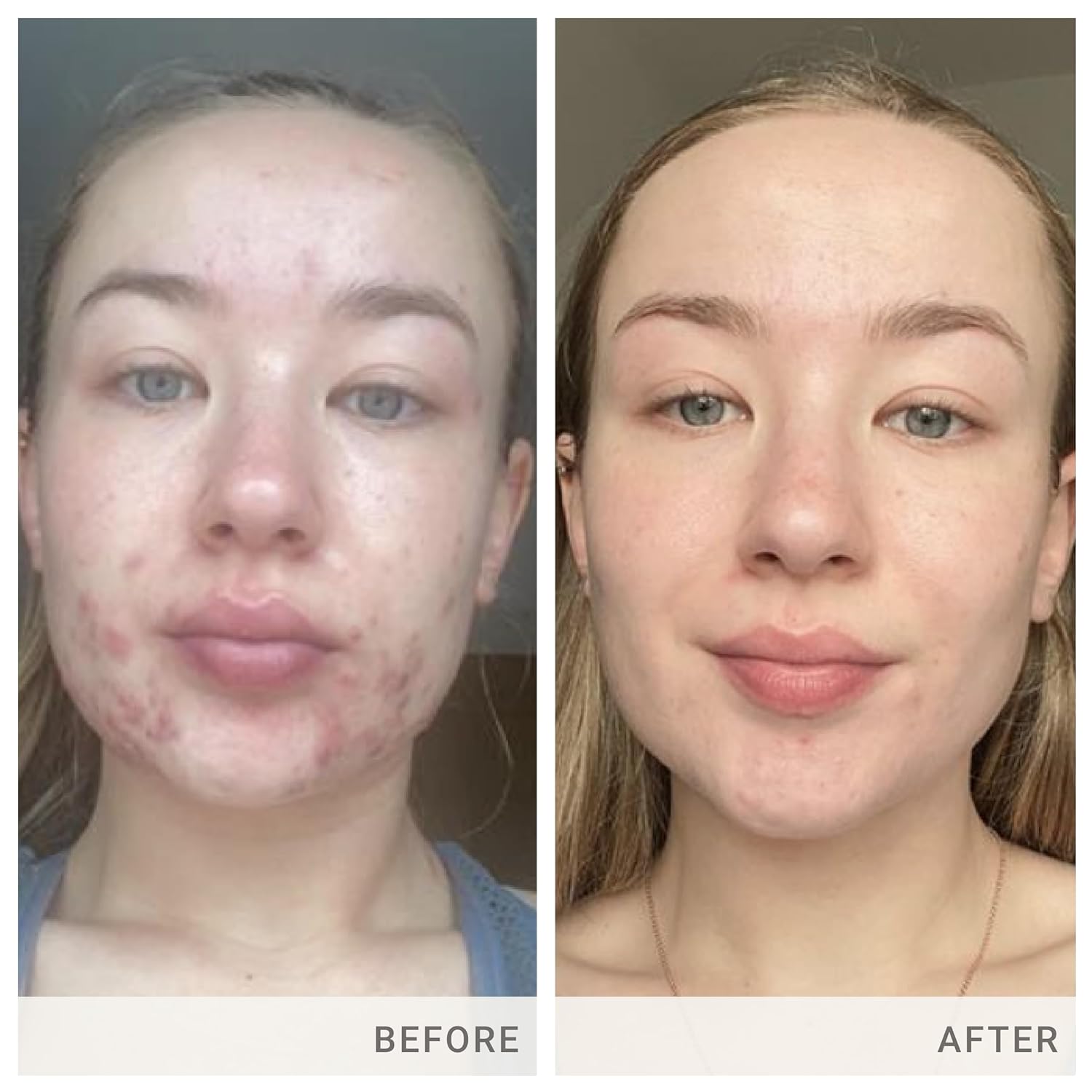 jane iredale Skin Accumax Capsules: Acne-Fighting Supplement with Vitamin A, C, and E - Vegan & Gluten-Free