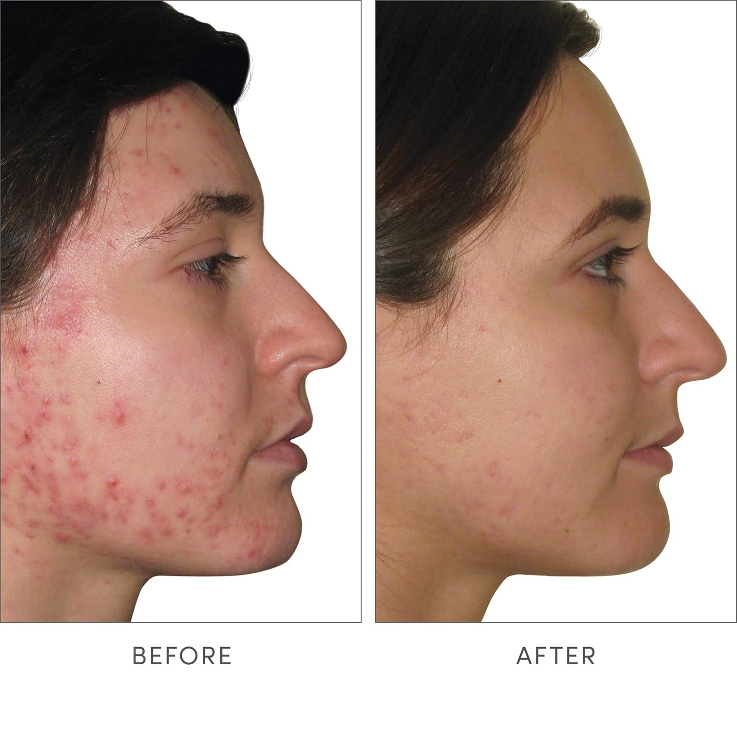 jane iredale Skin Accumax Capsules: Acne Treatment with Vitamin A, C, & E - Vegan & Gluten-Free
