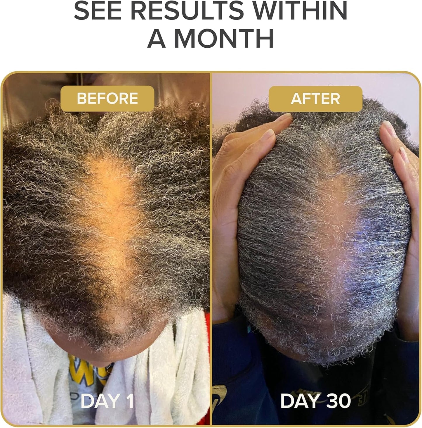 Shedavi Iconic Natural Hair Vitamins - Fast Hair Growth Supplement for Thicker, Stronger Hair - Vegan Formula for Hair Loss - Non-GMO Hair Care (60 Capsules)