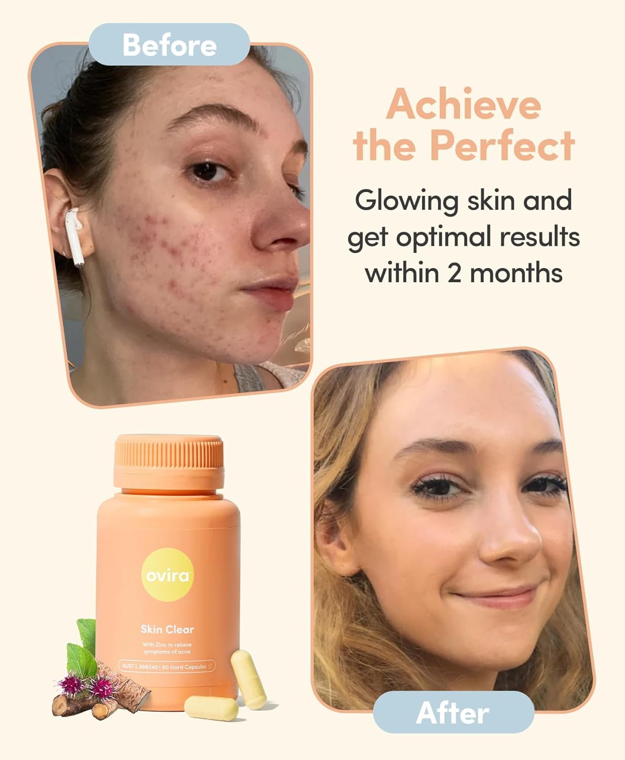 ZINCBRIGHT Skin Clear Capsules - Rosacea & Hormonal Acne Treatment for Glowing Skin | Supports Collagen Production | Acne Supplements for Men & Women - 120 Capsules